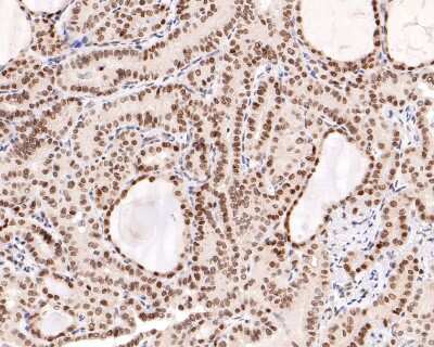 Immunohistochemistry-Paraffin: BANF1 Antibody (JG40-43) [NBP2-76978] - Analysis of paraffin-embedded human thyroid carcinoma tissue using anti-BANF1 antibody. The section was pre-treated using heat mediated antigen retrieval with sodium citrate buffer (pH 6.0) for 20 minutes. The tissues were blocked in 1% BSA for 30 minutes at room temperature, washed with ddH2O and PBS, and then probed with the primary antibody (1/400) for 30 minutes at room temperature. The detection was performed using an HRP conjugated compact polymer system. DAB was used as the chromogen. Tissues were counterstained with hematoxylin and mounted with DPX.