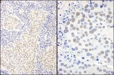 Immunohistochemistry: BANP Antibody [NB100-79784] - Sample: FFPE sections of human lung carcinoma (left) and mouse renal cell carcinoma (right). Antibody: Affinity purified rabbit anti-fs18 SMAR1 fs20 used at a dilution of 1:5,000 (0.2ug/ml). Detection: DAB