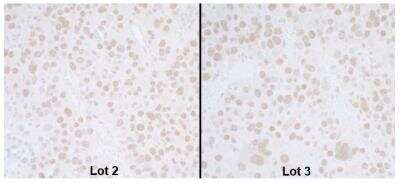 Immunohistochemistry: BANP Antibody [NB100-79784] - Detection of human SMAR1 by immunohistochemistry. Samples: FFPE sections of human lung carcinoma. Antibodies: Affinity purified rabbit anti-SMAR1 Cat. No. NB100-79784 Lot 2 used at a dilution of 1:5,000 (0.2ug/ml) (left) and Cat. No. NB100-79784 Lot3 used at a dilution of 1:5,000 (0.2ug/ml) (right). Detection: DAB