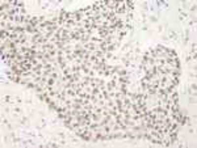 Immunohistochemistry-Paraffin: BANP Antibody [NB100-79784] - FFPE section of human breast tumor.   Affinity purified rabbit anti-SMAR1/BANP used at a dilution of 1:250.  Detection: DAB staining using Immunohistochemistry Accessory Kit