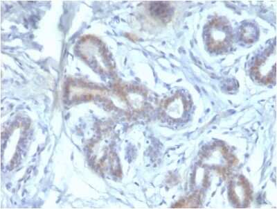 Immunohistochemistry-Paraffin: BAP1 Antibody (BAP1/2433) - Azide and BSA Free [NBP3-08494] - Formalin-fixed, paraffin-embedded human Breast carcinoma stained with BAP1 Mouse Monoclonal Antibody (BAP1/2433).