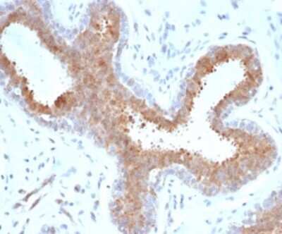 Immunohistochemistry-Paraffin: BAP1 Antibody (BAP1/6861R) [NBP3-13801] - Formalin-fixed, paraffin-embedded human breast carcinoma stained with BAP1 antibody (BAP1/6861R).