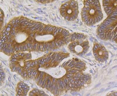 Immunohistochemistry-Paraffin: BCAP31 Antibody (JG37-81) [NBP2-75416] - Analysis of paraffin-embedded human colon cancer tissue using anti-BAP31 antibody. Counter stained with hematoxylin.