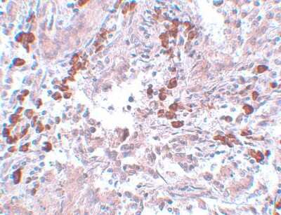 Immunohistochemistry-Paraffin: BCAS1 Antibody [NBP1-77123] - Human breast carcinoma with BCAS1 antibody at 5 ug/mL.