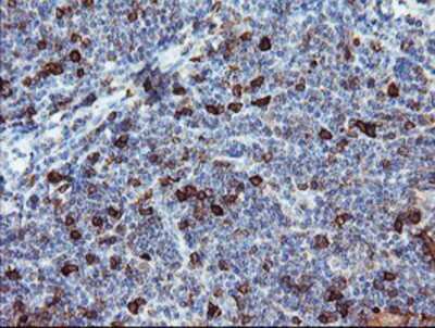 Immunohistochemistry-Paraffin: BCAT1 Antibody (3F5) [NBP2-01826] - Staining of paraffin-embedded Human lymphoma tissue using anti-BCAT1 mouse monoclonal antibody.