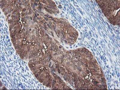 Immunohistochemistry: BCAT1 Antibody (OTI3F5) - Azide and BSA Free [NBP2-70242] - Staining of paraffin-embedded Adenocarcinoma of Human endometrium tissue using anti-BCAT1 mouse monoclonal antibody.