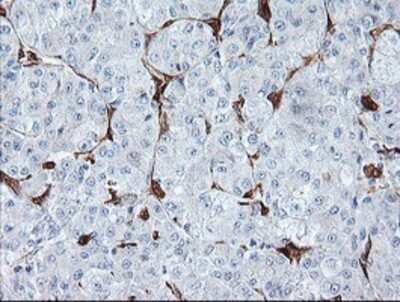 Immunohistochemistry: BCAT1 Antibody (OTI3F5) - Azide and BSA Free [NBP2-70242] - Staining of paraffin-embedded Carcinoma of Human liver tissue using anti-BCAT1 mouse monoclonal antibody.