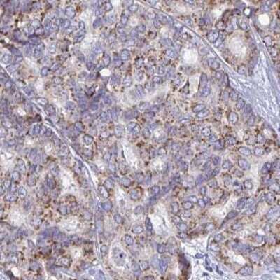 Immunohistochemistry-Paraffin: BCAT2 Antibody [NBP2-33705] - Staining of liver cancer.