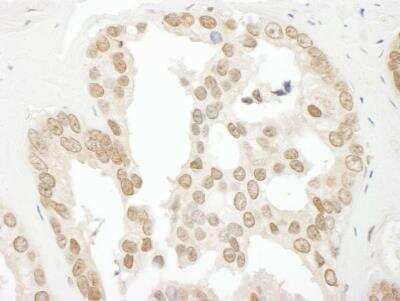 Immunohistochemistry-Paraffin: BCCIP Antibody [NBP1-22994] - Human prostate carcinoma. Antibody used at a dilution of 1:1000 (1ug/ml).