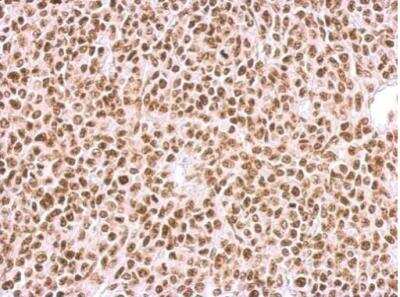 Immunohistochemistry-Paraffin: BCCIP Antibody [NBP1-31319] - Sample: Paraffin-embedded BT483 xenograft. BCCIP antibody dilution: 1:500.