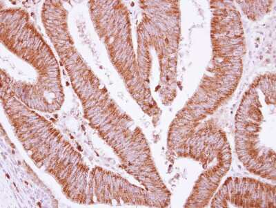 Immunohistochemistry-Paraffin: BCKDHA Antibody [NBP2-15552] -  Human colon carcinoma, using BCKDHA antibody at 1:250 dilution. Antigen Retrieval: Trilogy™ (EDTA based, pH 8.0) buffer, 15min. 