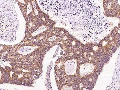 Immunohistochemistry-Paraffin: BCKDHA Antibody [NBP2-97503] - Immunochemical staining of human BCKDHA in human colon carcinoma with rabbit polyclonal antibody at 1:200 dilution, formalin-fixed paraffin embedded sections.