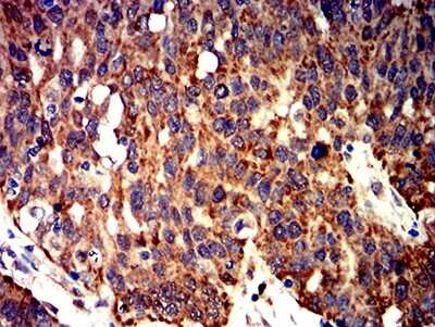 Immunohistochemistry: BCL-W/BCL2L2 Antibody (4G12E6) [NBP2-61706] - Analysis of paraffin-embedded ovarian cancer tissues using BCL2L2 mouse mAb with DAB staining.