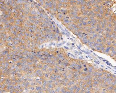 Immunohistochemistry-Paraffin: BCL2L12 Antibody (JE51-66) [NBP2-80451] - Analysis in human lung carcinoma tissue using BCL2L12 antibody. The section was pre-treated using heat mediated antigen retrieval with sodium citrate buffer (pH 6.0) for 20 minutes. The tissues were blocked in 5% BSA for 30 minutes at room temperature, wa