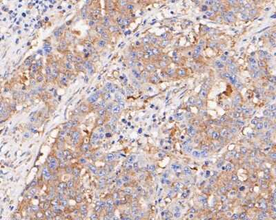 Immunohistochemistry-Paraffin: BCL2L12 Antibody (JE51-66) [NBP2-80451] - Analysis in human gastric carcinoma tissue using BCL2L12 antibody. The section was pre-treated using heat mediated antigen retrieval with sodium citrate buffer (pH 6.0) for 20 minutes. The tissues were blocked in 5% BSA for 30 minutes at room temperature,