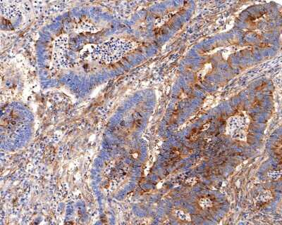Immunohistochemistry-Paraffin: BCL2L12 Antibody (JE51-66) [NBP2-80451] - Analysis of paraffin-embedded human colon carcinoma tissue using anti-BCL2L12 antibody. The section was pre-treated using heat mediated antigen retrieval with sodium citrate buffer (pH 6.0) for 20 minutes. The tissues were blocked in 1% BSA for 30 minutes at room temperature, washed with ddH2O and PBS, and then probed with the primary antibody (1/400) for 30 minutes at room temperature. The detection was performed using an HRP conjugated compact polymer system. DAB was used as the chromogen. Tissues were counterstained with hematoxylin and mounted with DPX.