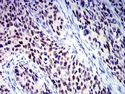 Immunohistochemistry: BCL9-2 Antibody (3B9C1) [NBP2-61823] - Analysis of paraffin-embedded cervical cancer tissues using BCL9L mouse mAb with DAB staining.