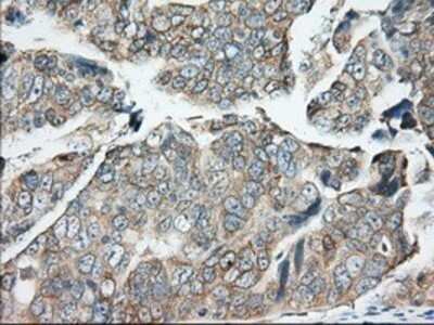 Immunohistochemistry: BDH2 Antibody (OTI2G1) - Azide and BSA Free [NBP2-72067] - Staining of paraffin-embedded Adenocarcinoma of Human ovary tissue using anti-BDH2 mouse monoclonal antibody.