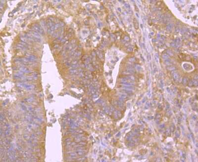 Immunohistochemistry-Paraffin: BID Antibody (JM11-14) [NBP2-67190] - Analysis of paraffin-embedded human colon cancer tissue using anti-Bid antibody. Counter stained with hematoxylin.