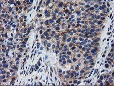 Immunohistochemistry-Paraffin: BIN3 Antibody (8E9) [NBP2-03389] - Staining of paraffin-embedded Carcinoma of Human bladder tissue using anti-BIN3 mouse monoclonal antibody.