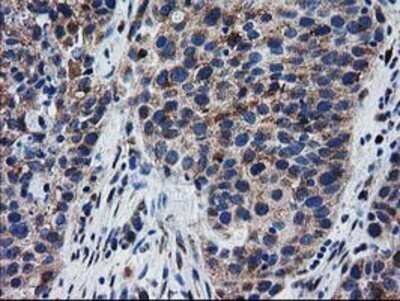Immunohistochemistry: BIN3 Antibody (OTI8E9) - Azide and BSA Free [NBP2-72051] - Staining of paraffin-embedded Carcinoma of Human bladder tissue using anti-BIN3 mouse monoclonal antibody.