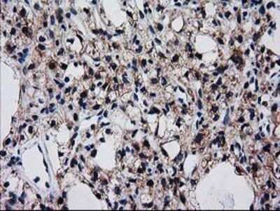 Immunohistochemistry: BIN3 Antibody (OTI8E9) - Azide and BSA Free [NBP2-72051] - Staining of paraffin-embedded Carcinoma of Human kidney tissue using anti-BIN3 mouse monoclonal antibody.