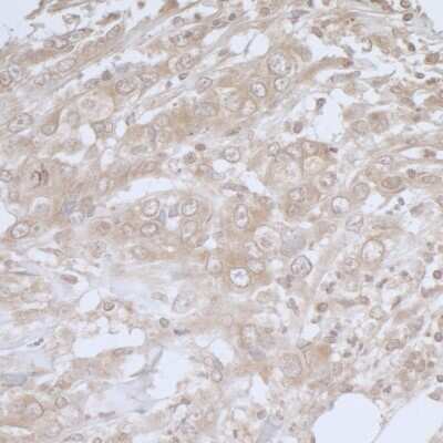 <b>Biological Strategies Validation. </b>Immunohistochemistry-Paraffin: BIRC6 Antibody [NB300-264] - Section of human breast carcinoma. Antibody: Affinity purified rabbit anti-BIRC6/Apollon used at a dilution of 1:5,000 (0.2ug/ml). Detection: DAB Coutnerstain: IHC Hematoxylin (blue).