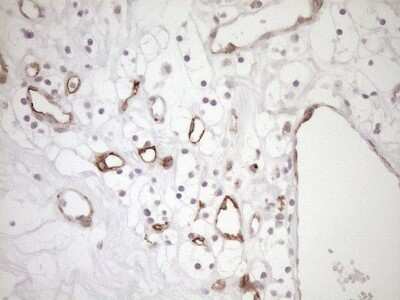 Immunohistochemistry: BLNK Antibody (4C9) [NBP2-46577] - Analysis of Carcinoma of Human kidney tissue.(Heat-induced epitope retrieval by 1mM EDTA in 10mM Tris buffer (pH8.5) at 120C for 3 min)