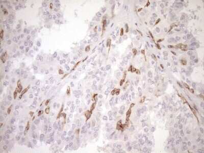 Immunohistochemistry: BLNK Antibody (4C9) [NBP2-46577] - Analysis of Carcinoma of Human thyroid tissue. (Heat-induced epitope retrieval by 1mM EDTA in 10mM Tris buffer (pH8.5) at 120C for 3 min)