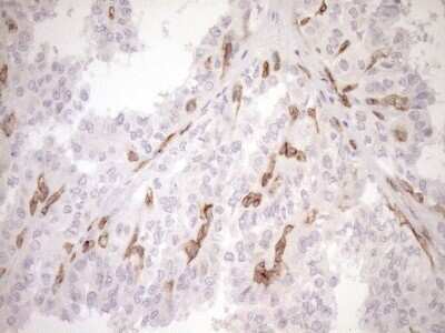 Immunohistochemistry: BLNK Antibody (OTI4C9) - Azide and BSA Free [NBP2-71855] - Analysis of Carcinoma of Human thyroid tissue. (Heat-induced epitope retrieval by 1mM EDTA in 10mM Tris buffer (pH8.5) at 120C for 3 min)