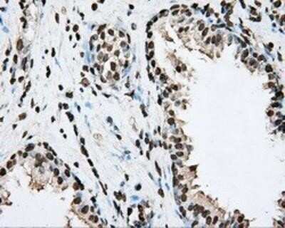 Immunohistochemistry: BMAL1 Antibody (OTI1C11) - Azide and BSA Free [NBP2-70207] - Staining of paraffin-embedded Carcinoma of prostate tissue using anti-BMAL1 mouse monoclonal antibody.