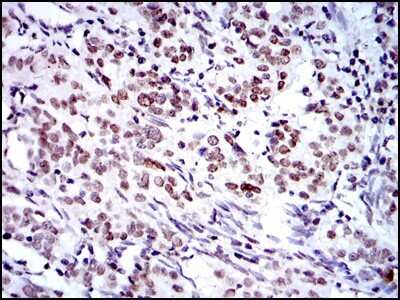 Immunohistochemistry-Paraffin: BMI-1 Antibody (3E3) [NBP2-22204] - Analysis of paraffin-embedded cervical cancer tissues using Bmi1 mouse mAb with DAB staining.