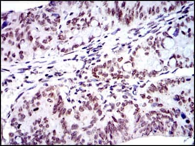 Immunohistochemistry-Paraffin: BMI-1 Antibody (3E3) [NBP2-22204] - Analysis of paraffin-embedded rectum cancer tissues using Bmi1 mouse mAb with DAB staining.