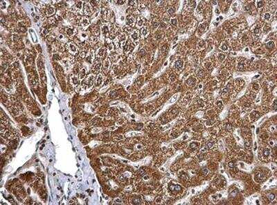 Immunohistochemistry-Paraffin: BMPR-IB/ALK-6 Antibody [NBP2-14889] - Paraffin-embedded human hepatoma. BMPR1B antibody [N3C3] dilution: 1:500.