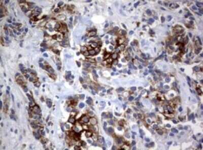 Immunohistochemistry: BNIP1 Antibody (OTI2B3) - Azide and BSA Free [NBP2-70257] - Analysis of Adenocarcinoma of Human breast tissue. (Heat-induced epitope retrieval by 10mM citric buffer, pH6.0, 120C for 3min)