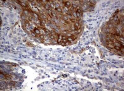 Immunohistochemistry: BNIP1 Antibody (OTI2B3) - Azide and BSA Free [NBP2-70257] - Analysis of Carcinoma of Human lung tissue. (Heat-induced epitope retrieval by 10mM citric buffer, pH6.0, 120C for 3min)