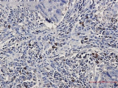 Immunohistochemistry-Paraffin: BNIP3L Antibody (S01-0F5) [NBP3-19585] - Immunohistochemistry of BNIP3L in paraffin-embedded Human lung cancer tissue using NBP3-19585 at dilution 1/50