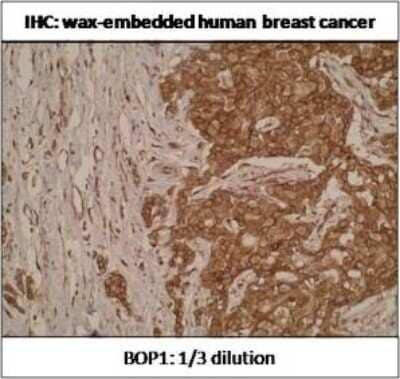 Immunohistochemistry-Paraffin: BOP1 Antibody (T7-P1B7-A8) [NBP2-50124] - Analysis of BOP1 in a paraffin embedded human breast cancer cross section.