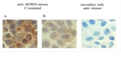 Immunohistochemistry: BORIS Antibody (20B11) [NBP2-52405] - Analysis using the supernatants from the clone 20B11 at following dilutions: (A) 20B11 undiluted supernatant and (B) 20B11 at 1:25. (B) Cells have been counterstained with the nuclear marker hematoxylin (blue). Images were taken at x60 magnification using the Olympus BX41 microscope. Expression of BORIS protein is indicated by the presence of brown staining, with a pattern characteristic for BORIS ( both, cytoplasmic and nuclear).