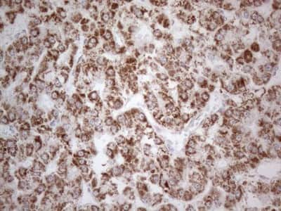 Immunohistochemistry: BP1 Antibody (8A1) [NBP2-46463] - Analysis of Carcinoma of Human liver tissue.(Heat-induced epitope retrieval by 1mM EDTA in 10mM Tris buffer (pH8.5) at 120C for 3 min)