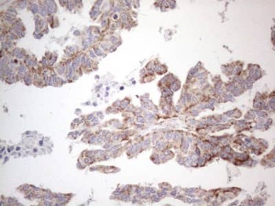 Immunohistochemistry: BP1 Antibody (8A1) [NBP2-46463] - Analysis of Adenocarcinoma of Human ovary tissue. (Heat-induced epitope retrieval by 1mM EDTA in 10mM Tris buffer (pH8.5) at 120C for 3 min)