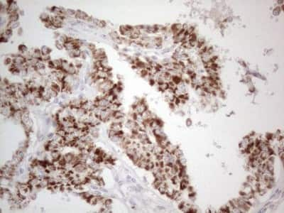 Immunohistochemistry: BP1 Antibody (8A1) [NBP2-46463] - Analysis of Carcinoma of Human thyroid tissue. (Heat-induced epitope retrieval by 1mM EDTA in 10mM Tris buffer (pH8.5) at 120C for 3 min)