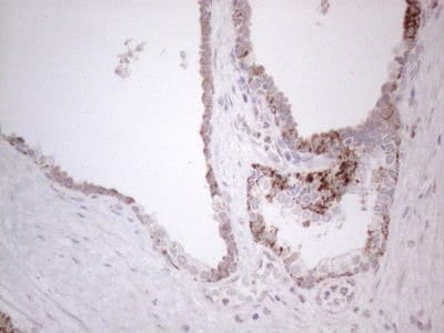 Immunohistochemistry: BP1 Antibody (8A1) [NBP2-46463] - Analysis of Carcinoma of Human prostate tissue. (Heat-induced epitope retrieval by 1mM EDTA in 10mM Tris buffer (pH8.5) at 120C for 3 min)