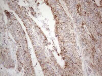 Immunohistochemistry: BP1 Antibody (OTI8A1) - Azide and BSA Free [NBP2-70581] - Analysis of Adenocarcinoma of Human colon tissue. (Heat-induced epitope retrieval by 1mM EDTA in 10mM Tris buffer (pH8.5) at 120C for 3 min)
