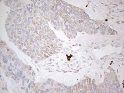 Immunohistochemistry: BP1 Antibody (OTI8A1) - Azide and BSA Free [NBP2-70581] - Analysis of Adenocarcinoma of Human endometrium tissue. (Heat-induced epitope retrieval by 1mM EDTA in 10mM Tris buffer (pH8.5) at 120C for 3 min)