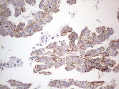 Immunohistochemistry: BP1 Antibody (OTI8A1) - Azide and BSA Free [NBP2-70581] - Analysis of Adenocarcinoma of Human ovary tissue. (Heat-induced epitope retrieval by 1mM EDTA in 10mM Tris buffer (pH8.5) at 120C for 3 min)