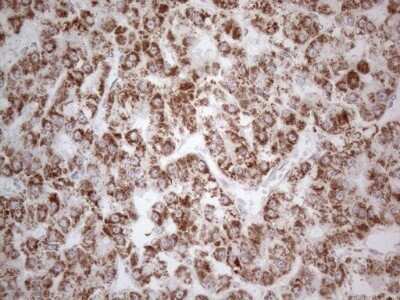 Immunohistochemistry: BP1 Antibody (OTI8A1) - Azide and BSA Free [NBP2-70581] - Analysis of Carcinoma of Human liver tissue.(Heat-induced epitope retrieval by 1mM EDTA in 10mM Tris buffer (pH8.5) at 120C for 3 min)