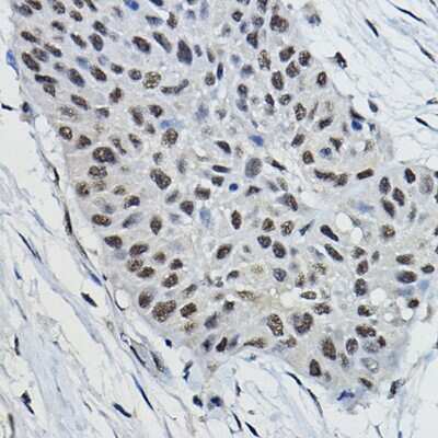 Immunohistochemistry-Paraffin: BRAP Antibody [NBP2-92871] - Immunohistochemistry of paraffin-embedded human lung cancer using BRAP Rabbit pAb (NBP2-92871) at dilution of 1:100 (40x lens). Perform high pressure antigen retrieval with 10 mM citrate buffer pH 6.0 before commencing with IHC staining protocol.