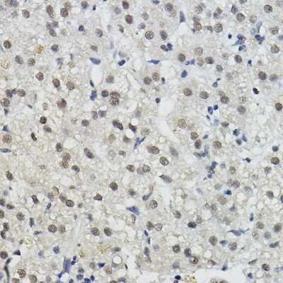 Immunohistochemistry-Paraffin: BRAP Antibody [NBP2-92871] - Immunohistochemistry of paraffin-embedded human liver cancer using BRAP Rabbit pAb (NBP2-92871) at dilution of 1:100 (40x lens). Perform high pressure antigen retrieval with 10 mM citrate buffer pH 6.0 before commencing with IHC staining protocol.