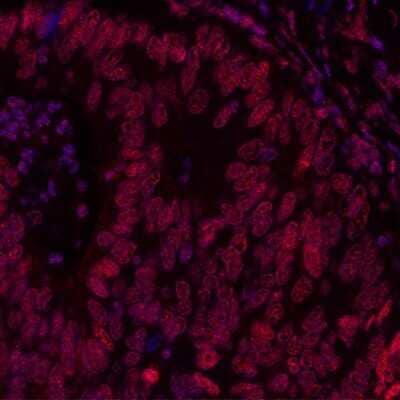 Immunohistochemistry: BRD3 Antibody (BLR069G) [NBP2-77359] - Detection of human BRD3 FFPE colon carcinoma by IHC. Antibody: Rabbit anti-BRD3 recombinant monoclonal [BLR069G] NBP2-77359. Secondary: DyLight® 594-conjugated goat anti-rabbit IgG. Counterstain: DAPI (blue).